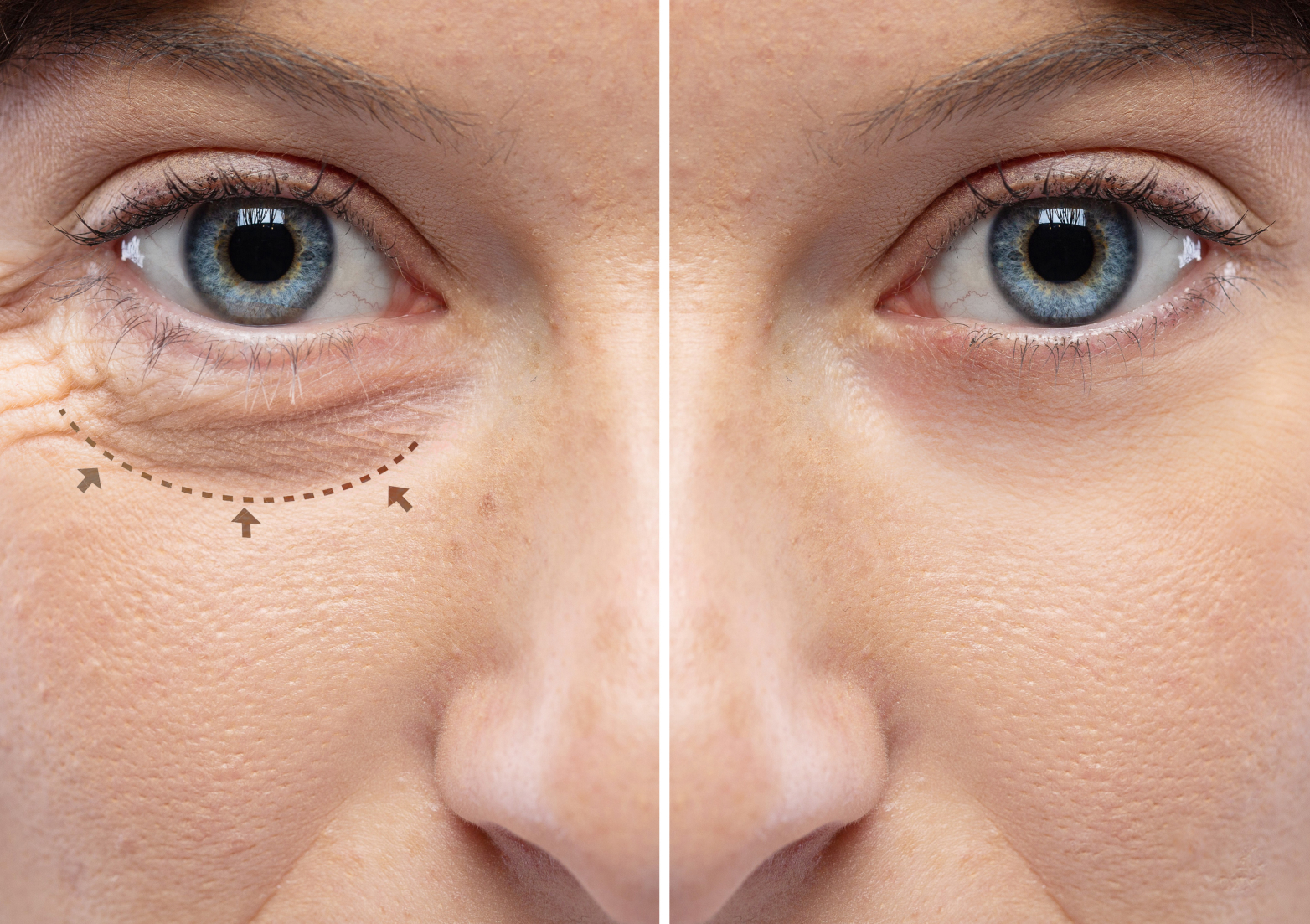 blefaroplastia-tres-lagoas